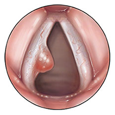 Vocal Cord Polyps