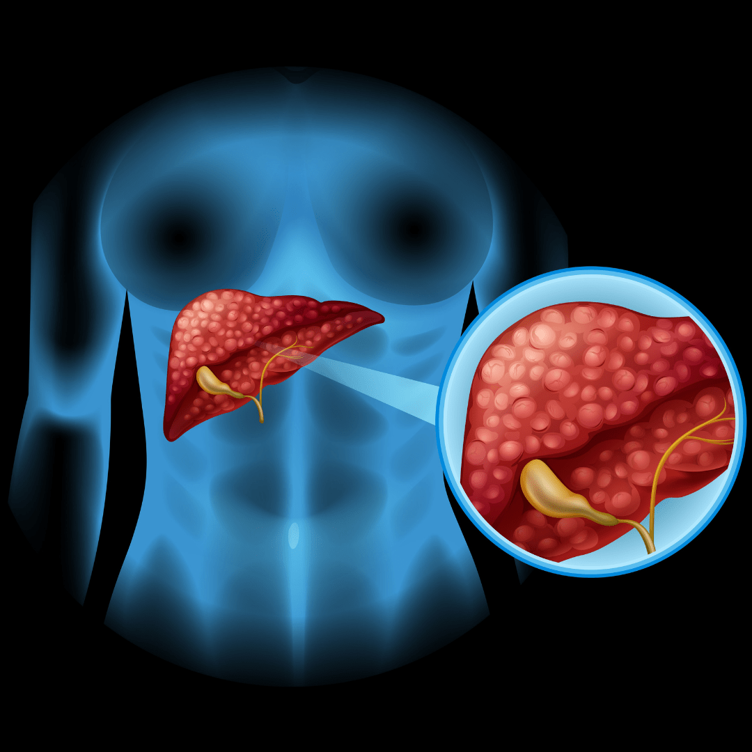 肝纖維化掃描(Fibroscan)